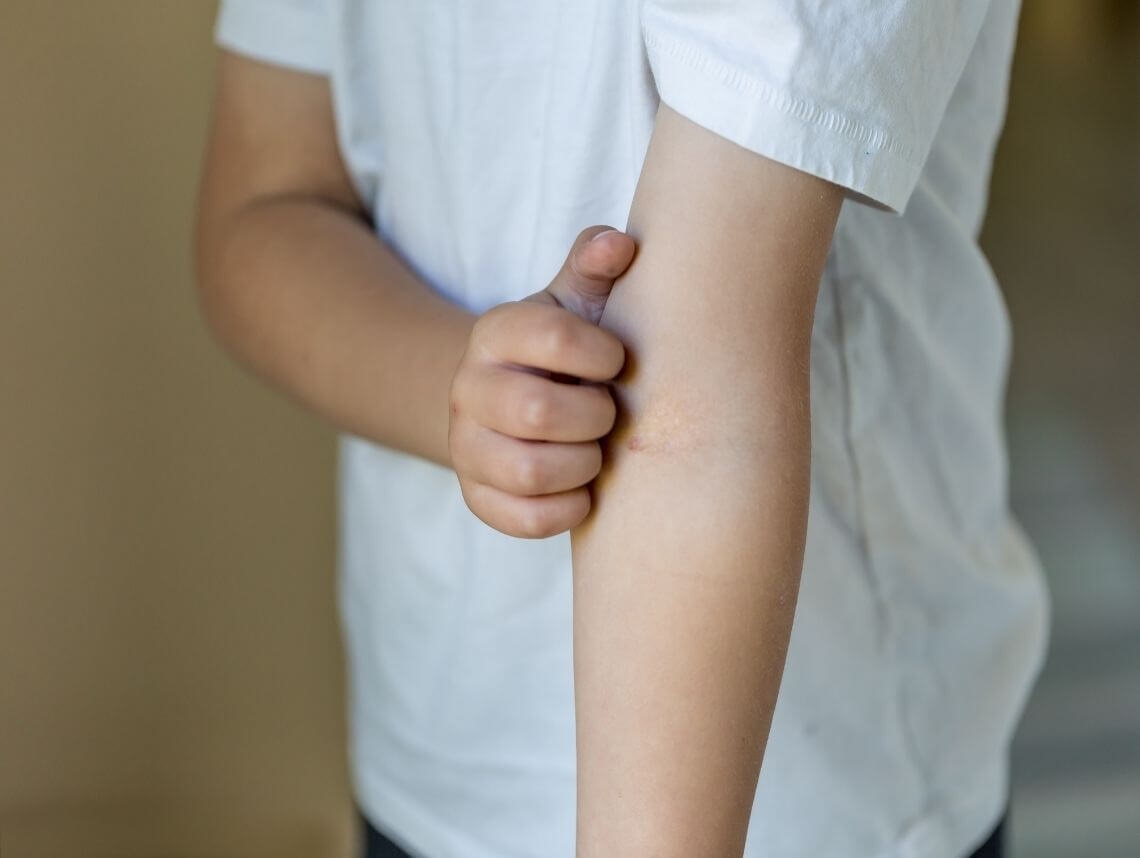 child scratching arm with rash scabies skin infection itching