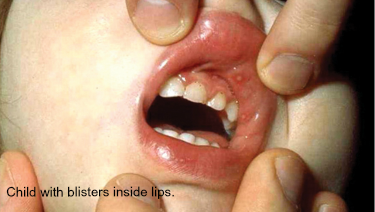hand foot mouth rash from healthy children website blister disease illness fever
