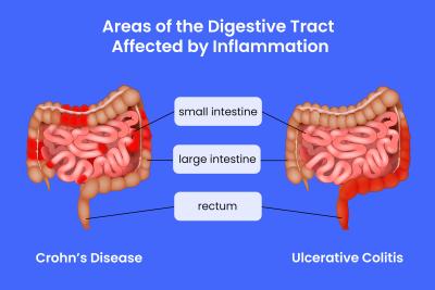 crohn's and colitis comparison image illustration