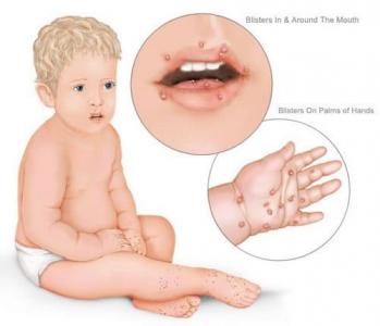 Baby Heat Rash: Symptoms, Causes And Treatments – Forbes Health