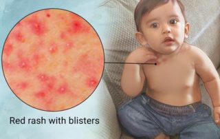 Five Common Summer Rashes – What's What and Proper Treatment