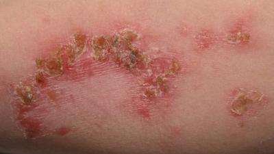 The 5 Most Common Summertime Rashes and How to Avoid Them