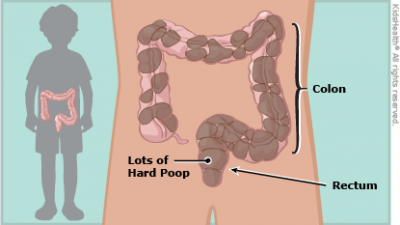 constipation illustration