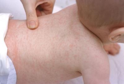 roseola baby rash skin bumps fever virus
