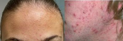 teen-acne-images